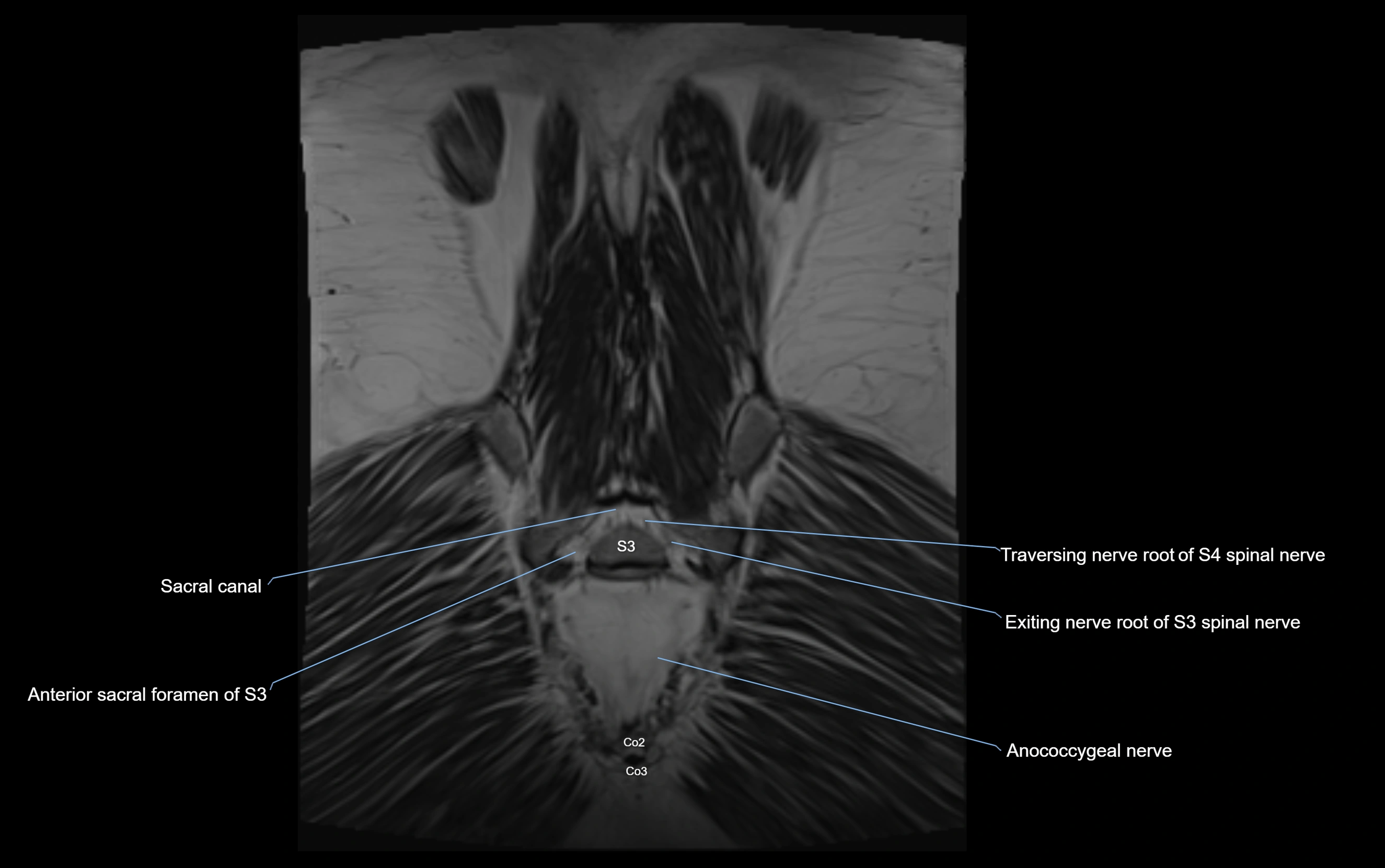 MR lumbosacral plexus cross sectional anatomy 3T  radiology  image-img-09001-00076.webp